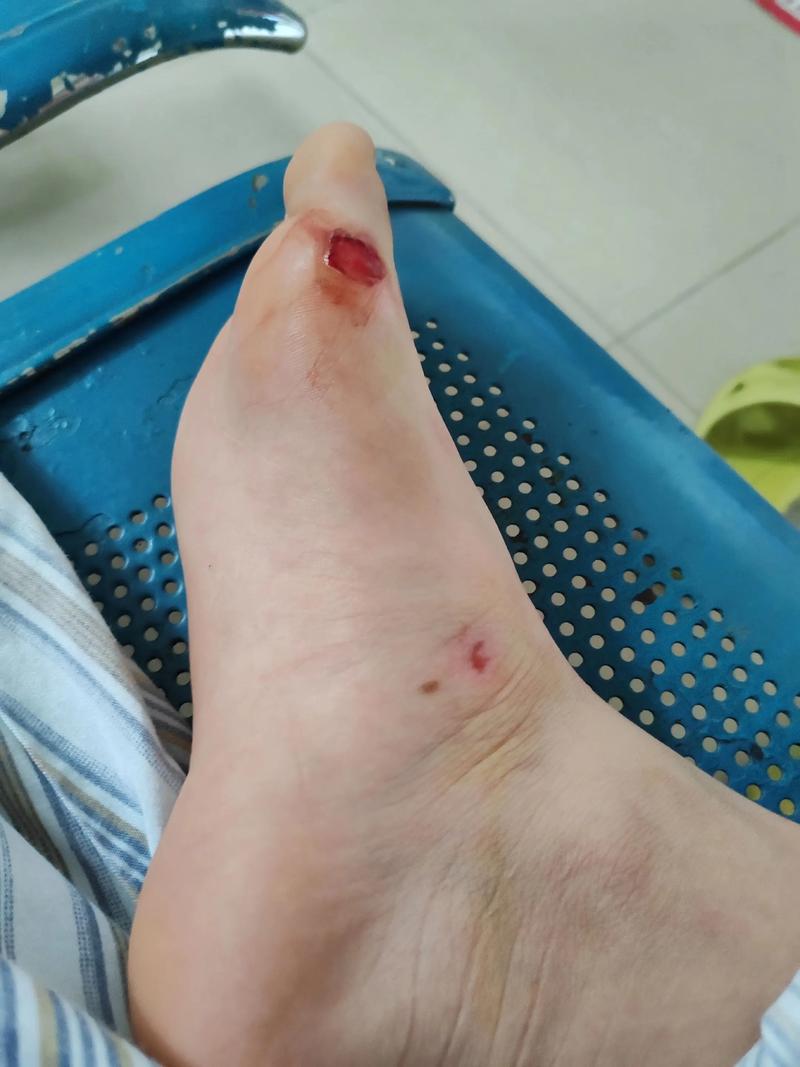 记者：帕尔默晚上在家时左脚小脚趾不小心撞到了门上，导致受伤